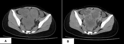 A case report of CIC–DUX4 fusion-positive sarcoma in the pelvic cavity with targeted next-generation sequencing results